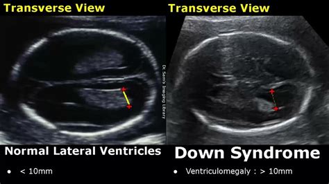 Fetal breasts in normal and Down syndrome fetuses